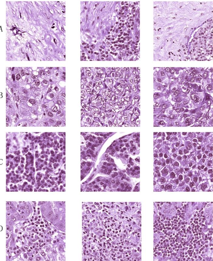 A figure from Deep Learning for Prediction of Hepatocellular Carcinoma Recurrence After Resection or Liver Transplantation: a Discovery and Validation Study