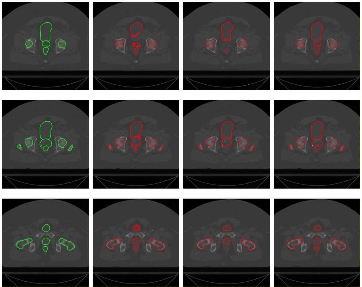 A figure from ARPM‐net: A novel CNN‐based adversarial method with Markov random field enhancement for prostate and organs at risk segmentation in pelvic CT images