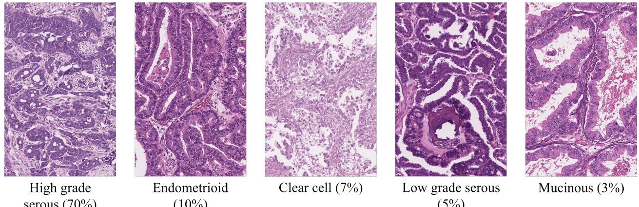 A figure from Efficient subtyping of ovarian cancer histopathology whole slide images using active sampling in multiple instance learning