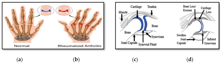A figure from Development of Rheumatoid Arthritis Classification from Electronic Image Sensor Using Ensemble Method