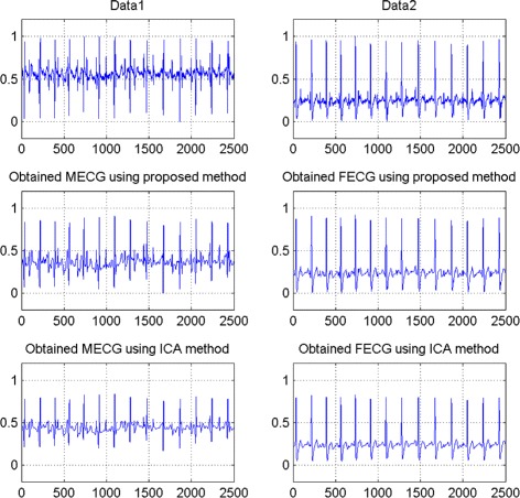 A figure from A new method for the extraction of fetal ECG from the dependent abdominal signals using blind source separation and adaptive noise cancellation techniques