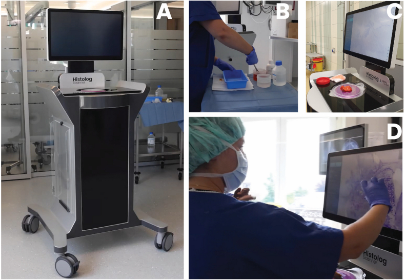 A figure from Imaging of lumpectomy surface with large field-of-view confocal laser scanning microscope for intraoperative margin assessment - POLARHIS study