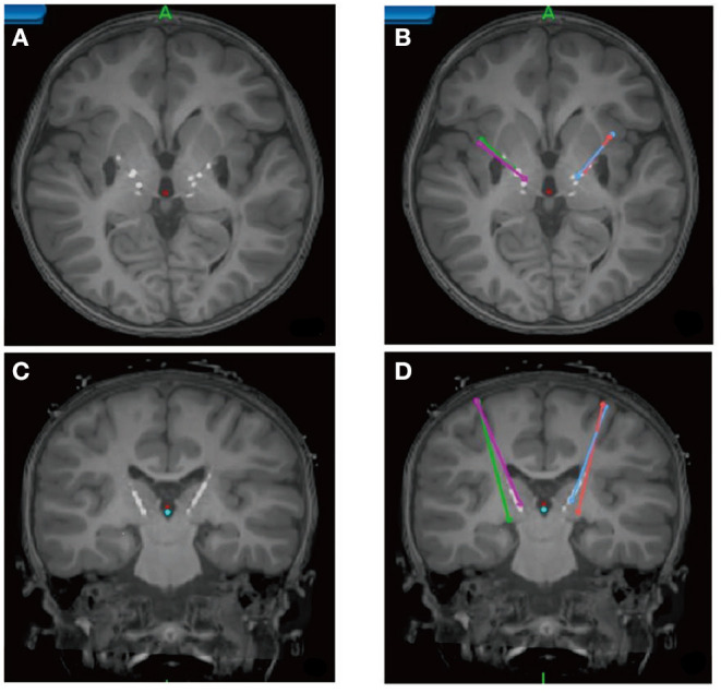 A figure from Deep Brain Stimulation Initiative: Toward Innovative Technology, New Disease Indications, and Approaches to Current and Future Clinical Challenges in Neuromodulation Therapy