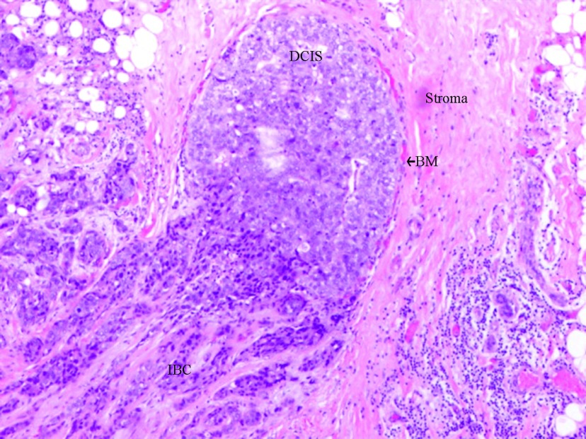 A figure from Ductal carcinoma <i> in situ </i> of the breast: morphological and molecular features implicated in progression Progression of ductal carcinoma <i> in situ </i> D. M. Carraro, E. V. Elias and V. P. Andrade