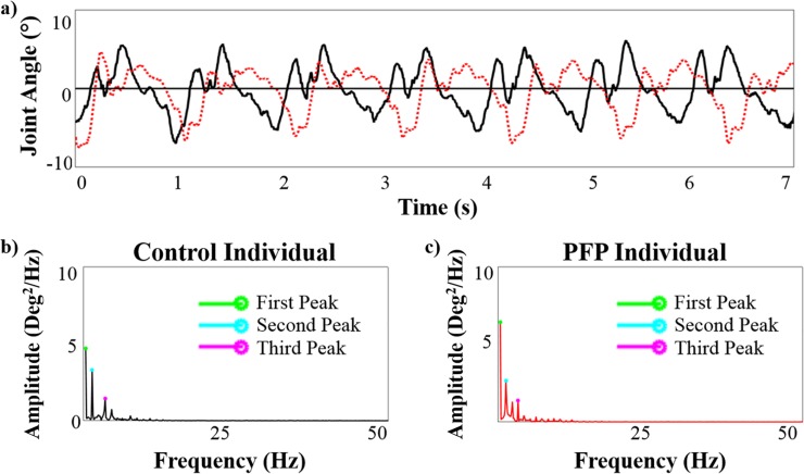 A figure from Identification of knee gait waveform pattern alterations in individuals with patellofemoral pain using fast Fourier transform Knee gait waveform pattern alterations in individuals with patellofemoral pain using fast Fourier transform