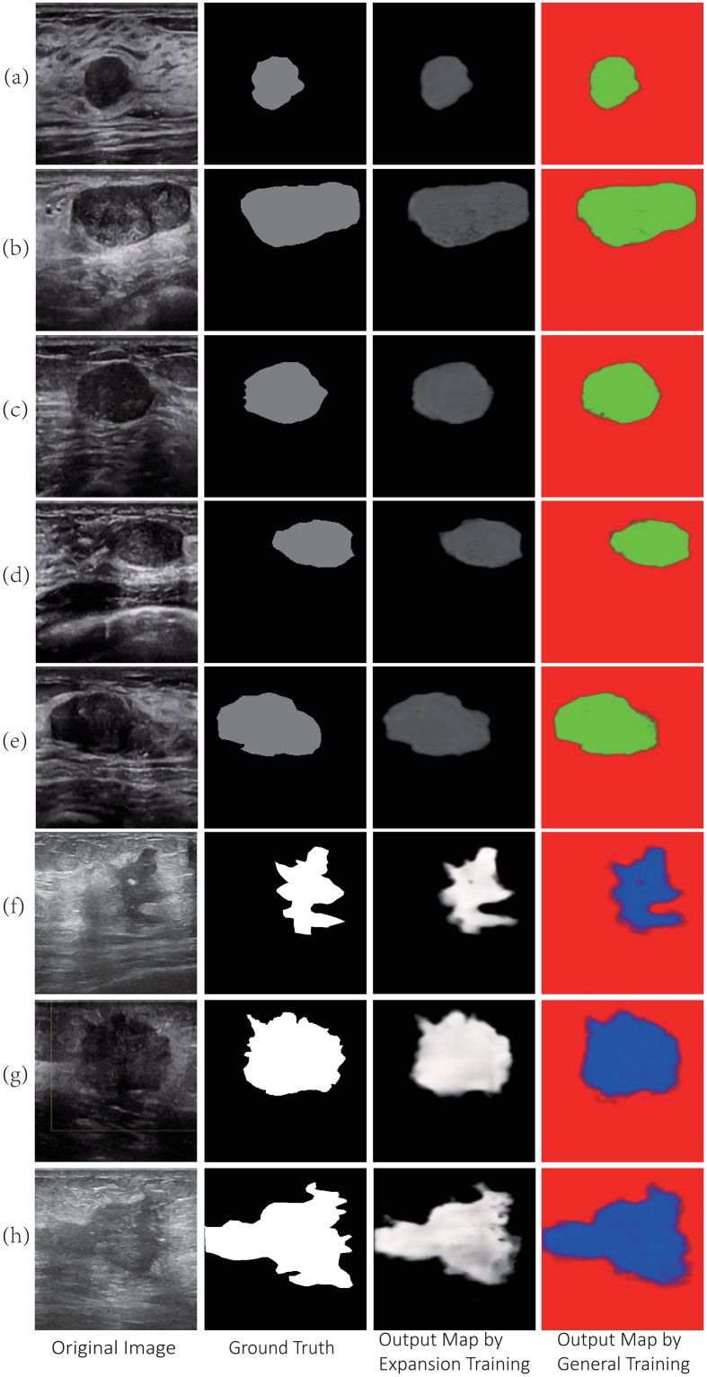 A figure from Segmentation and recognition of breast ultrasound images based on an expanded U-Net Segmentation and recognition of breast ultrasound images