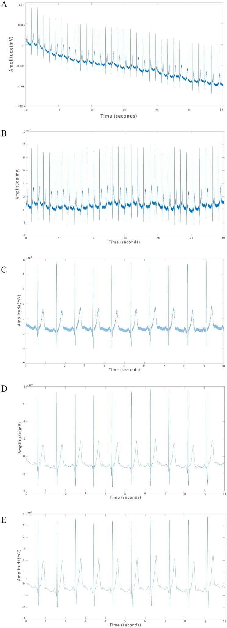 A figure from Prediction of hyperkalemia in ESRD patients by identification of multiple leads and multiple features on ECG D. Xu et al.
