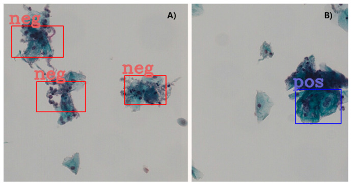 A figure from Detection of Cervical Cancer Cells in Whole Slide Images Using Deformable and Global Context Aware Faster RCNN-FPN