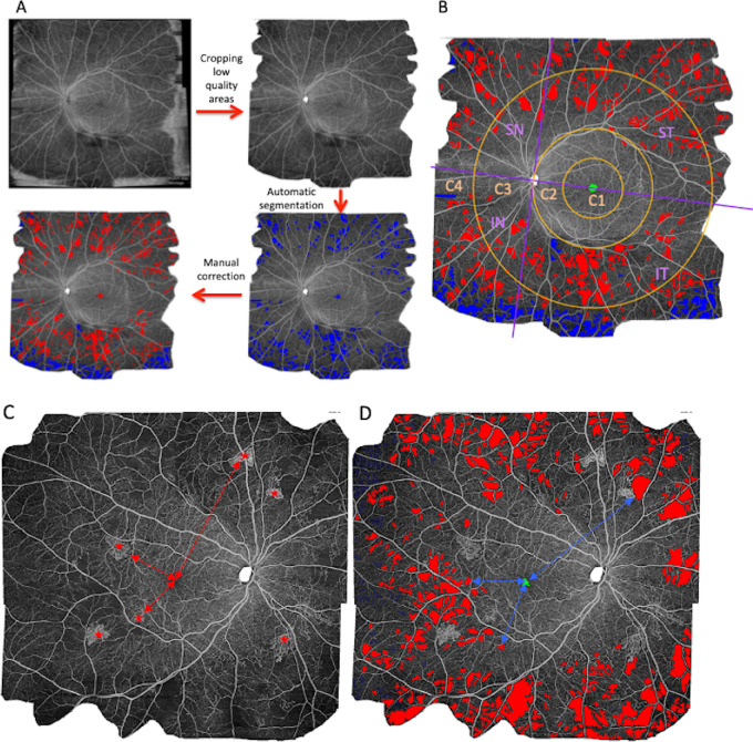 A figure from Is There a Nonperfusion Threshold on OCT Angiography Associated With New Vessels Detected on Ultra-Wide-Field Imaging in Diabetic Retinopathy? Nonperfusion Area to Diagnose Diabetic Retinopathy