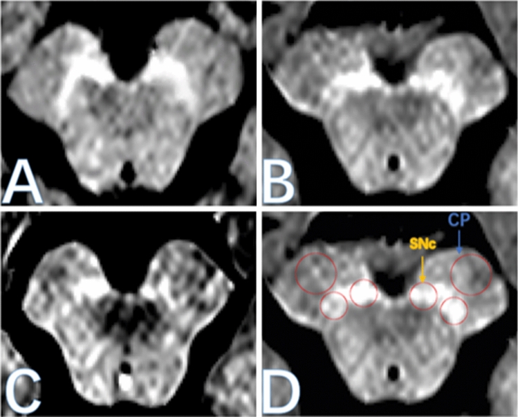 A figure from Substantia nigra neuromelanin magnetic resonance imaging in patients with different subtypes of Parkinson disease
