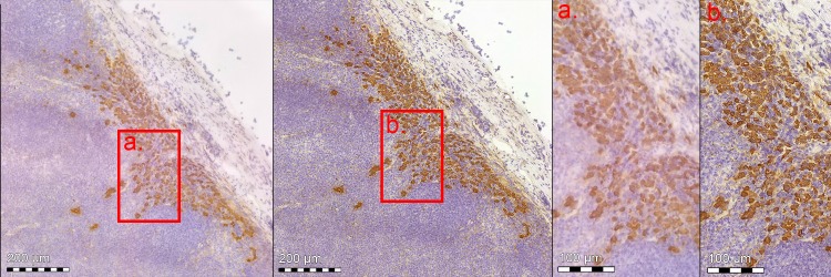 A figure from Detection of breast cancer lymph node metastases in frozen sections with a point-of-care low-cost microscope scanner Low-cost point-of-care digital microscopy for frozen section analysis