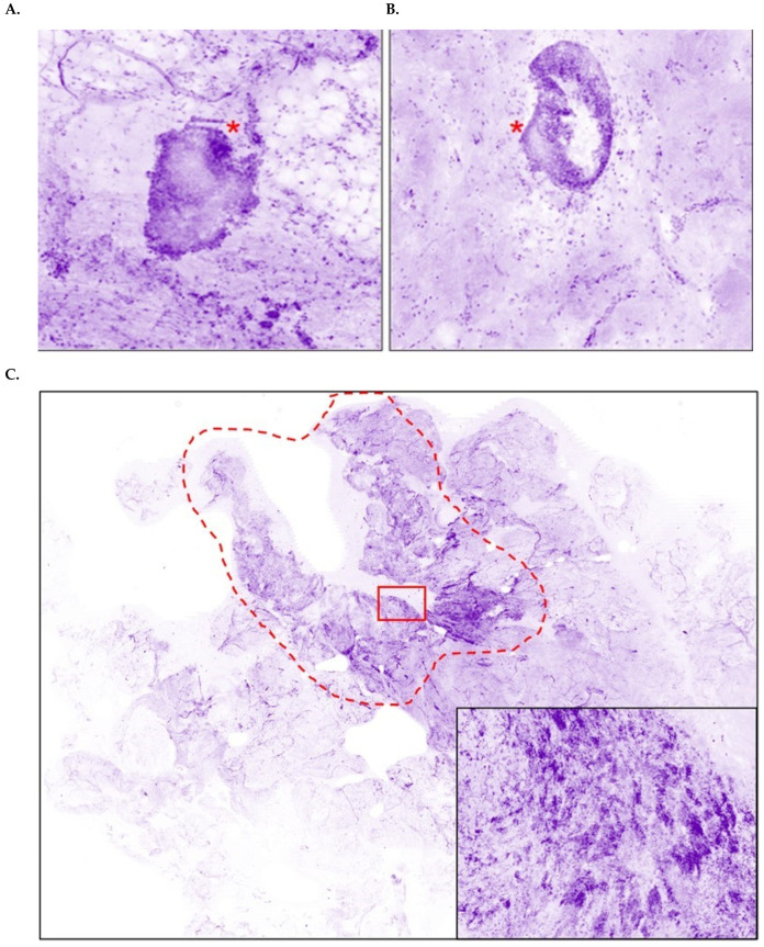 A figure from Confocal Microscopy for Intraoperative Margin Assessment of Lumpectomies by Surgeons in Breast Cancer: Training, Implementation in Routine Practice, and Two-Year Retrospective Analysis