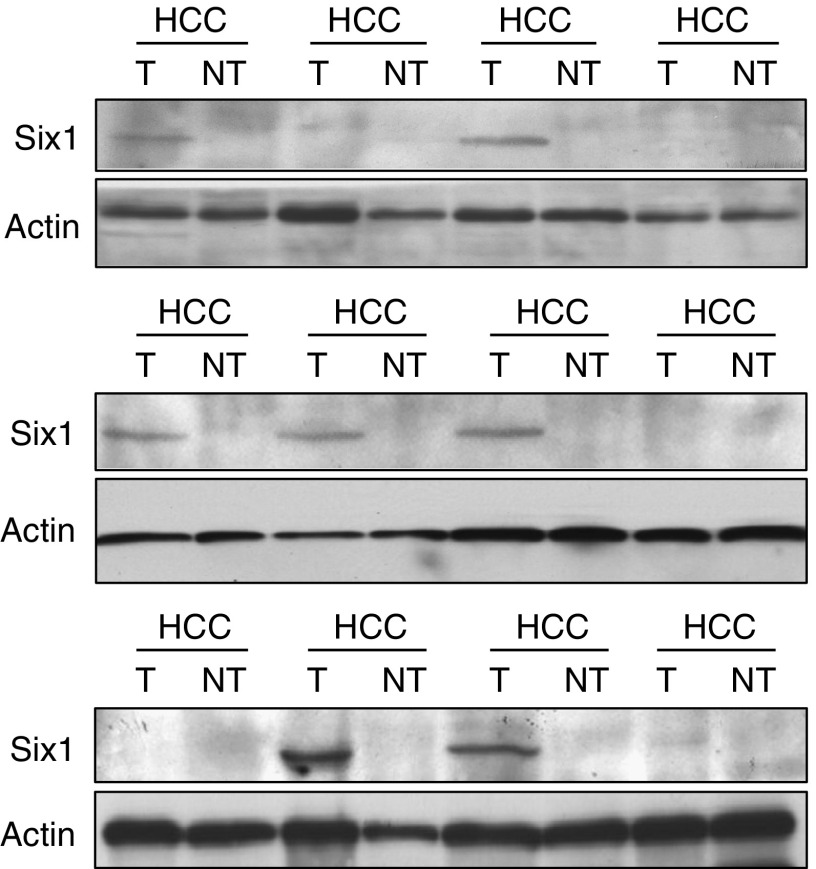 A figure from Clinicopathological significance of homeoprotein Six1 in hepatocellular carcinoma The role of Six1 in hepatocellular carcinoma