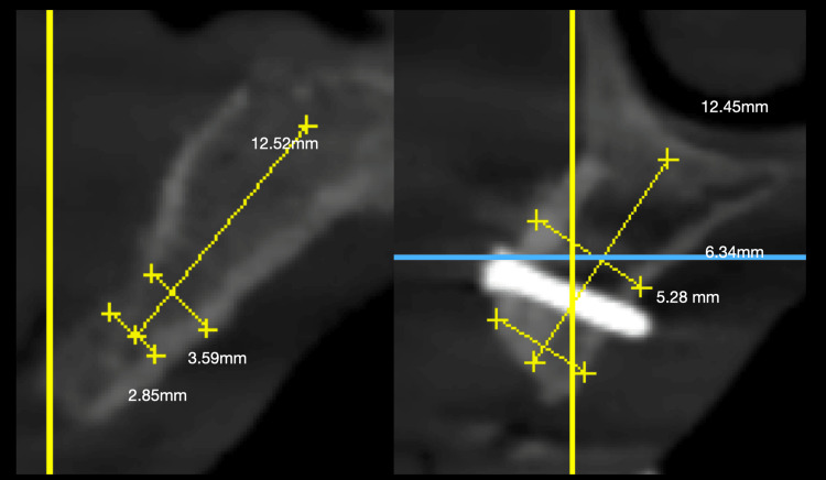 A figure from Evaluation of the Success of Autogenous Block Grafting in Atrophic Maxillary and Mandibular Ridges Prior to and After Implant Placement