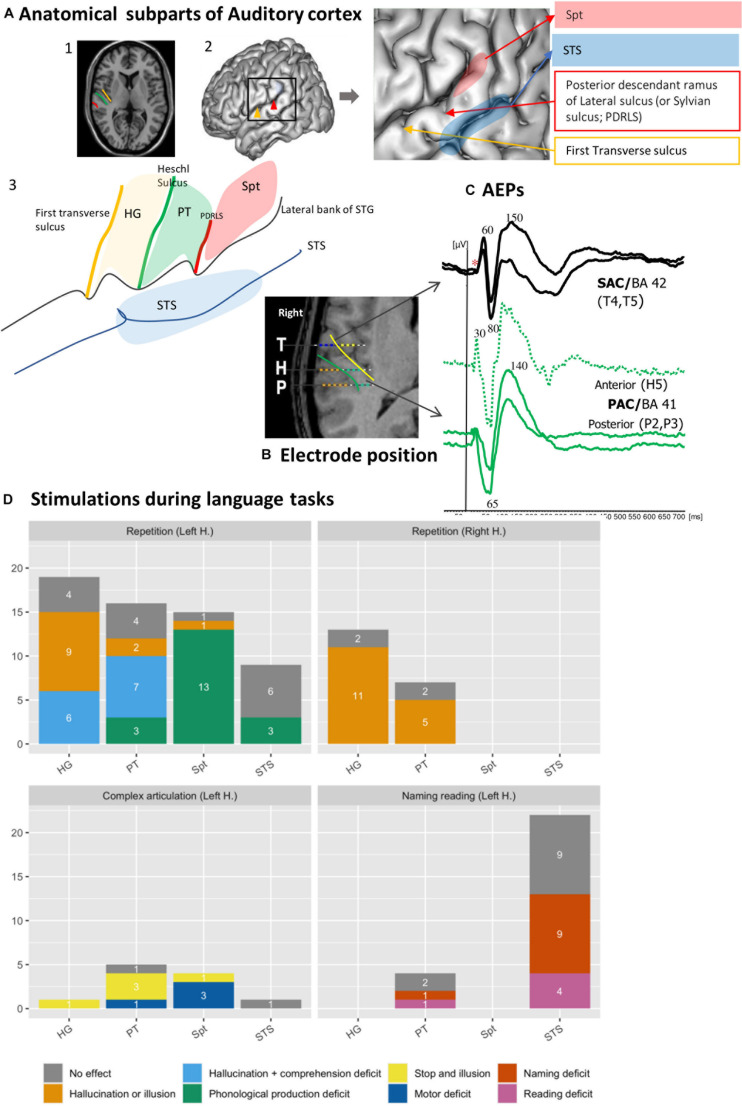 A figure from Functional Topography of Auditory Areas Derived From the Combination of Electrophysiological Recordings and Cortical Electrical Stimulation