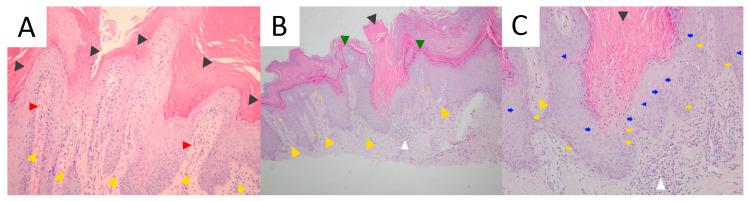 A figure from Porokeratoses—A Comprehensive Review on the Genetics and Metabolomics, Imaging Methods and Management of Common Clinical Variants