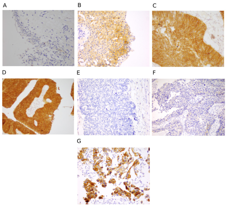 A figure from Diagnostic and Prognostic Implications of FGFR3, TP53 Mutation and Urinary Biomarkers in Urothelial Carcinoma in Pakistani Cohort