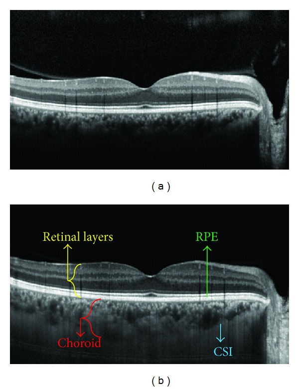 A figure from Segmentation of Choroidal Boundary in Enhanced Depth Imaging OCTs Using a Multiresolution Texture Based Modeling in Graph Cuts