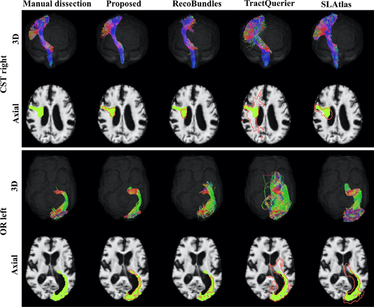 A figure from Automated three-dimensional major white matter bundle segmentation using diffusion magnetic resonance imaging