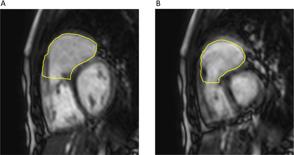 A figure from Improved right ventricular outflow tract function in patients with Tetralogy of Fallot after infundibular sparing compared to transventricular repair