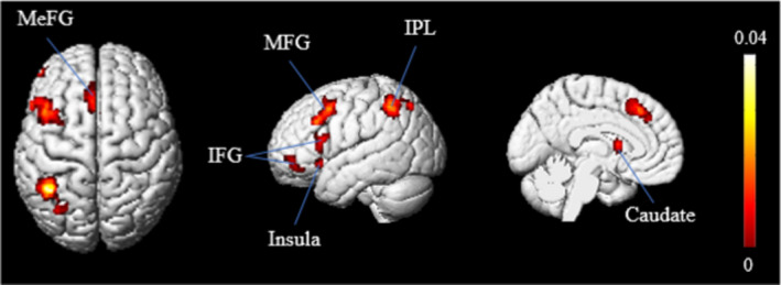 A figure from Deductive‐reasoning brain networks: A coordinate‐based meta‐analysis of the neural signatures in deductive reasoning WANG et al.