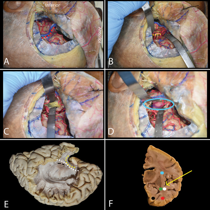 A figure from Anatomical considerations in selective amygdalohippocampectomy techniques for refractory temporal lobe epilepsy: a cadaveric study with emphasis on white matter tract anatomy