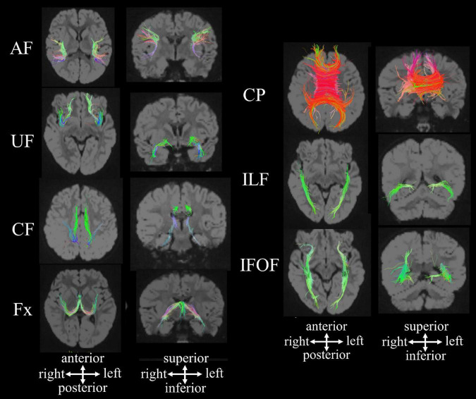 A figure from Quantitative Structural Brain Magnetic Resonance Imaging Analyses: Methodological Overview and Application to Rett Syndrome