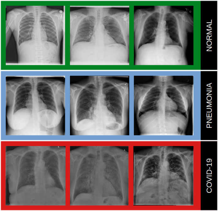 A figure from Pre-processing methods in chest X-ray image classification Pre-processing methods in chest X-ray image classification