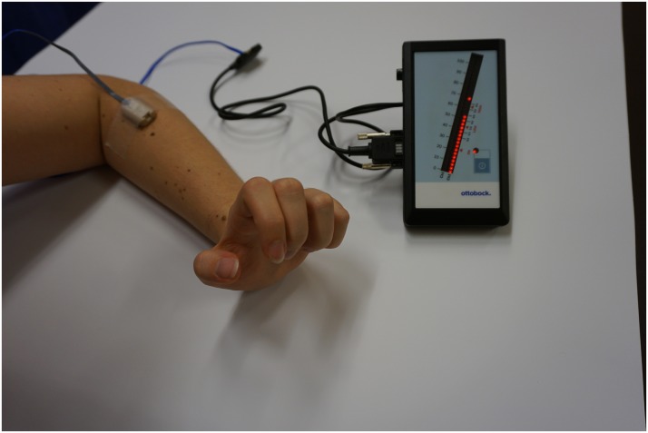 A figure from Rehabilitation of Upper Extremity Nerve Injuries Using Surface EMG Biofeedback: Protocols for Clinical Application