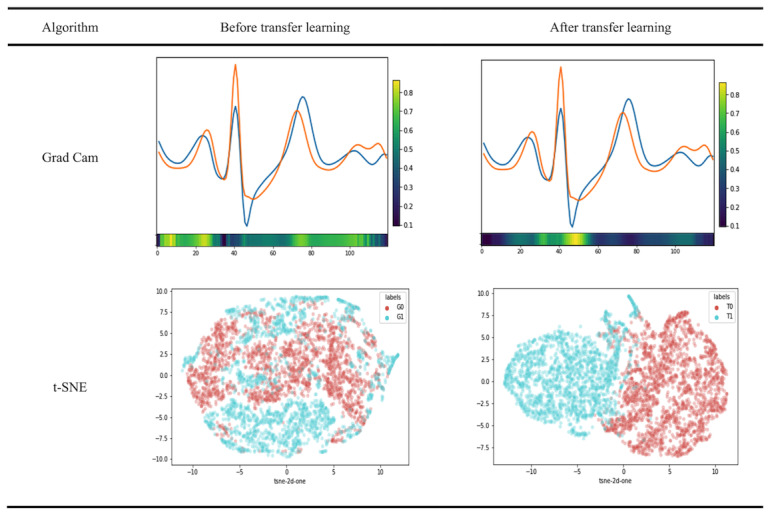 A figure from Using Deep Transfer Learning to Detect Hyperkalemia From Ambulatory Electrocardiogram Monitors in Intensive Care Units: Personalized Medicine Approach