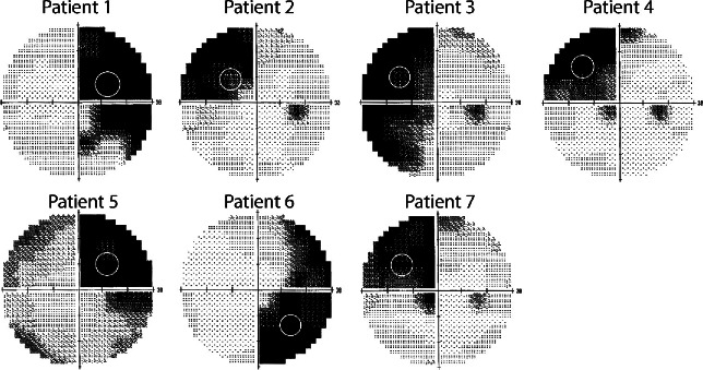 A figure from Visual training in hemianopia alters neural activity in the absence of behavioural improvement: a pilot study