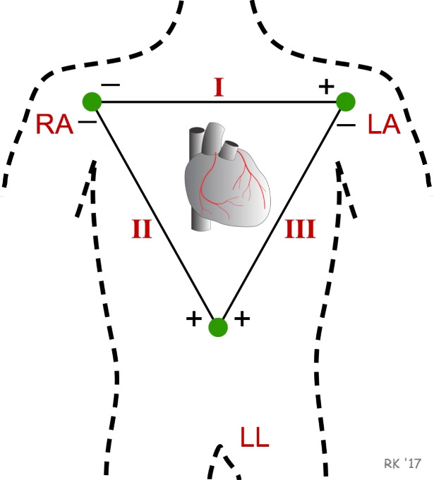 A figure from Comparative evaluation of filtration techniques for ECG signal denoising with emphasis on stationary wavelet transform