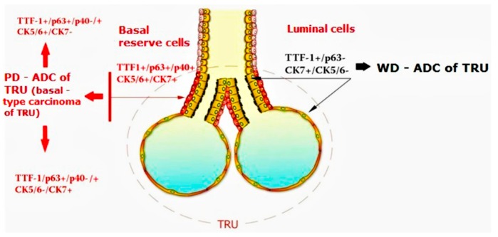 A figure from TTF-1/p63-Positive Poorly Differentiated NSCLC: A Histogenetic Hypothesis from the Basal Reserve Cell of the Terminal Respiratory Unit